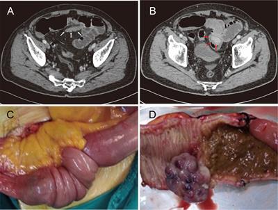 Case report and literature review: Small bowel intussusception due to solitary metachronous metastasis from renal cell carcinoma